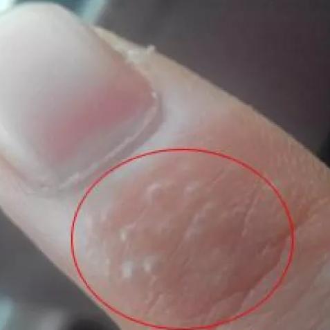 脚上起小水泡还很痒是怎么回事？一文读懂原因与应对方法